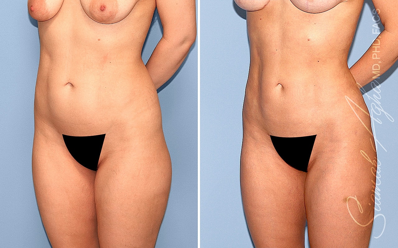 Liposuction Before & After