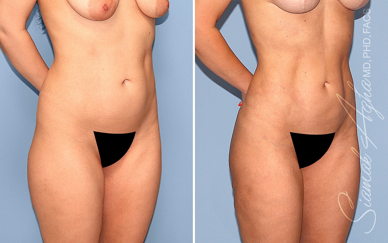 Liposuction Before & After