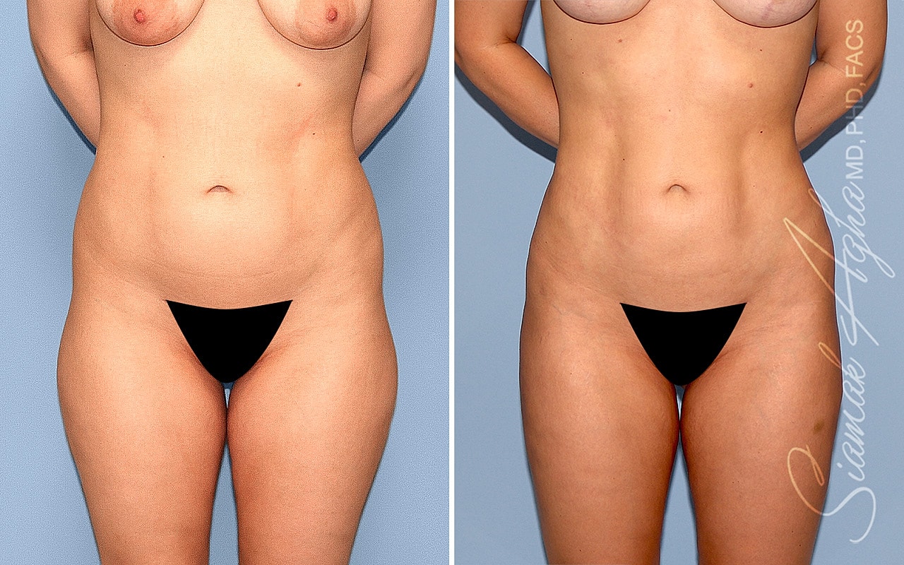 Liposuction Before & After