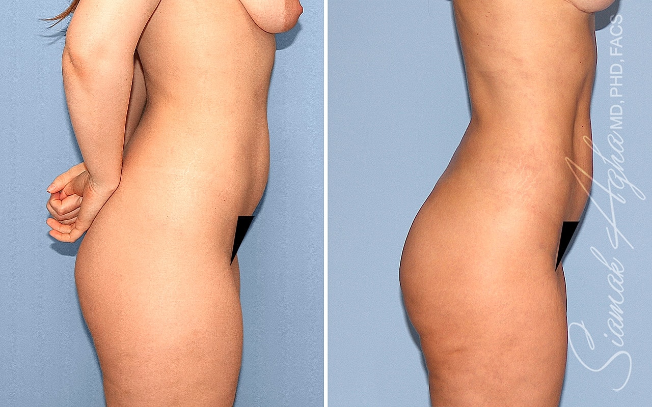 Liposuction Before & After