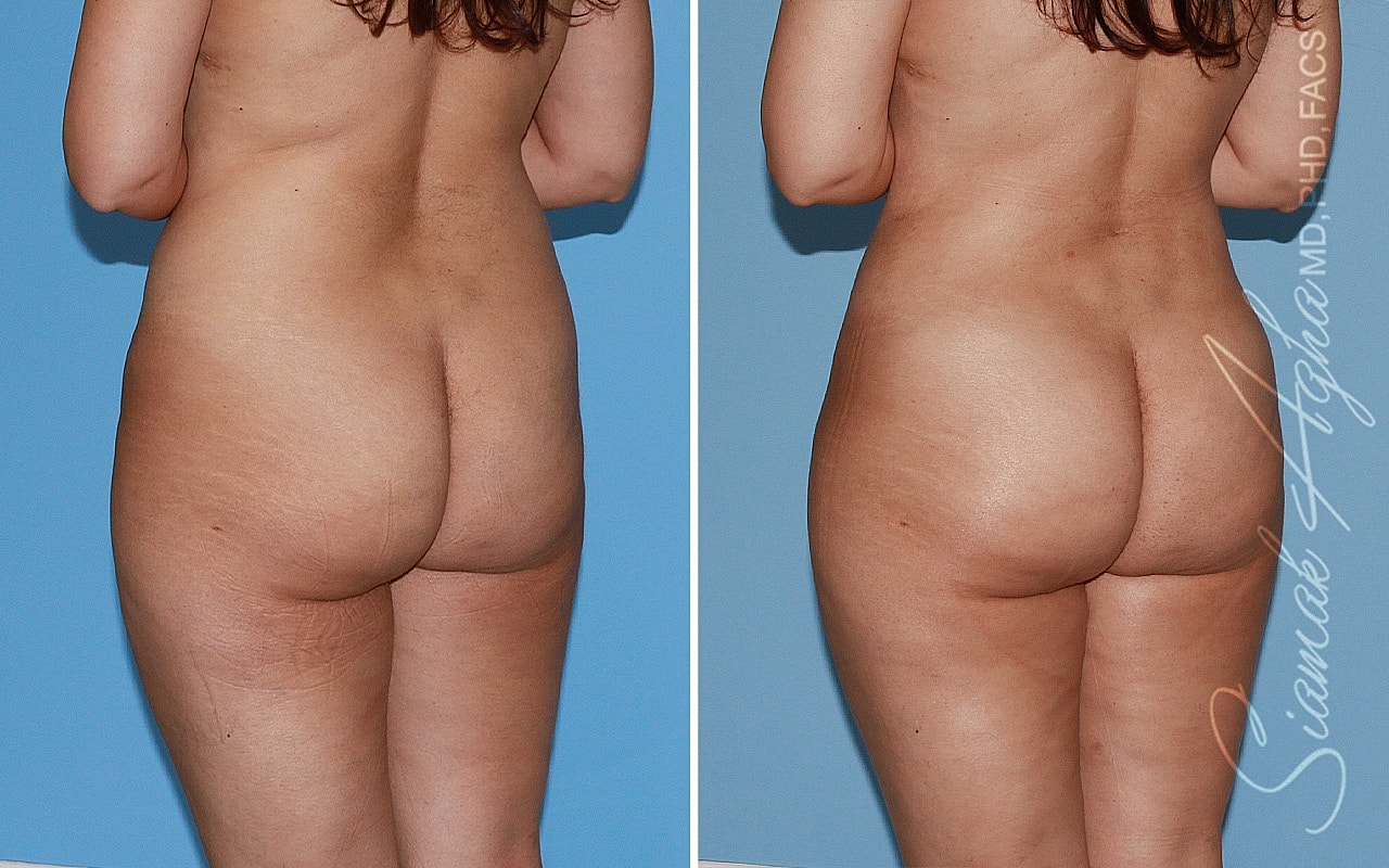 Liposuction Before & After