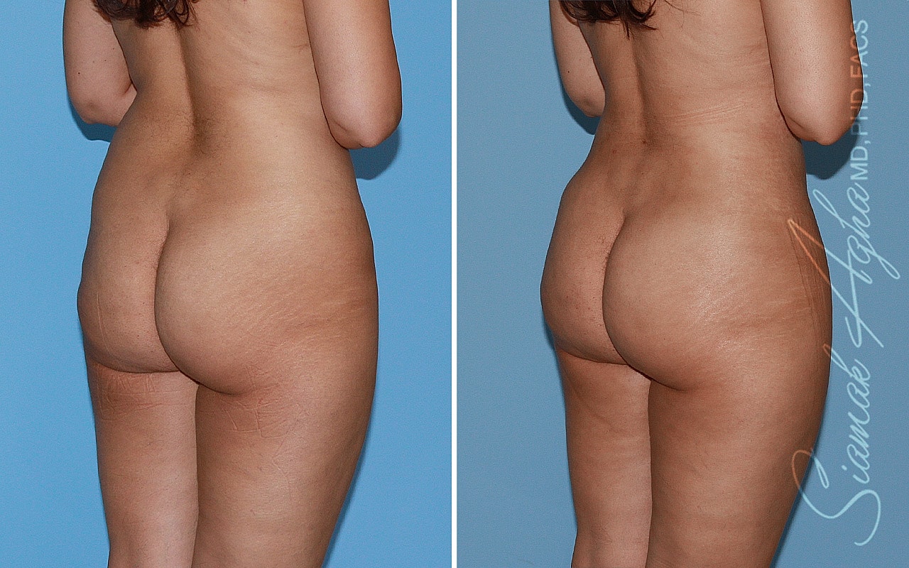 Liposuction Before & After