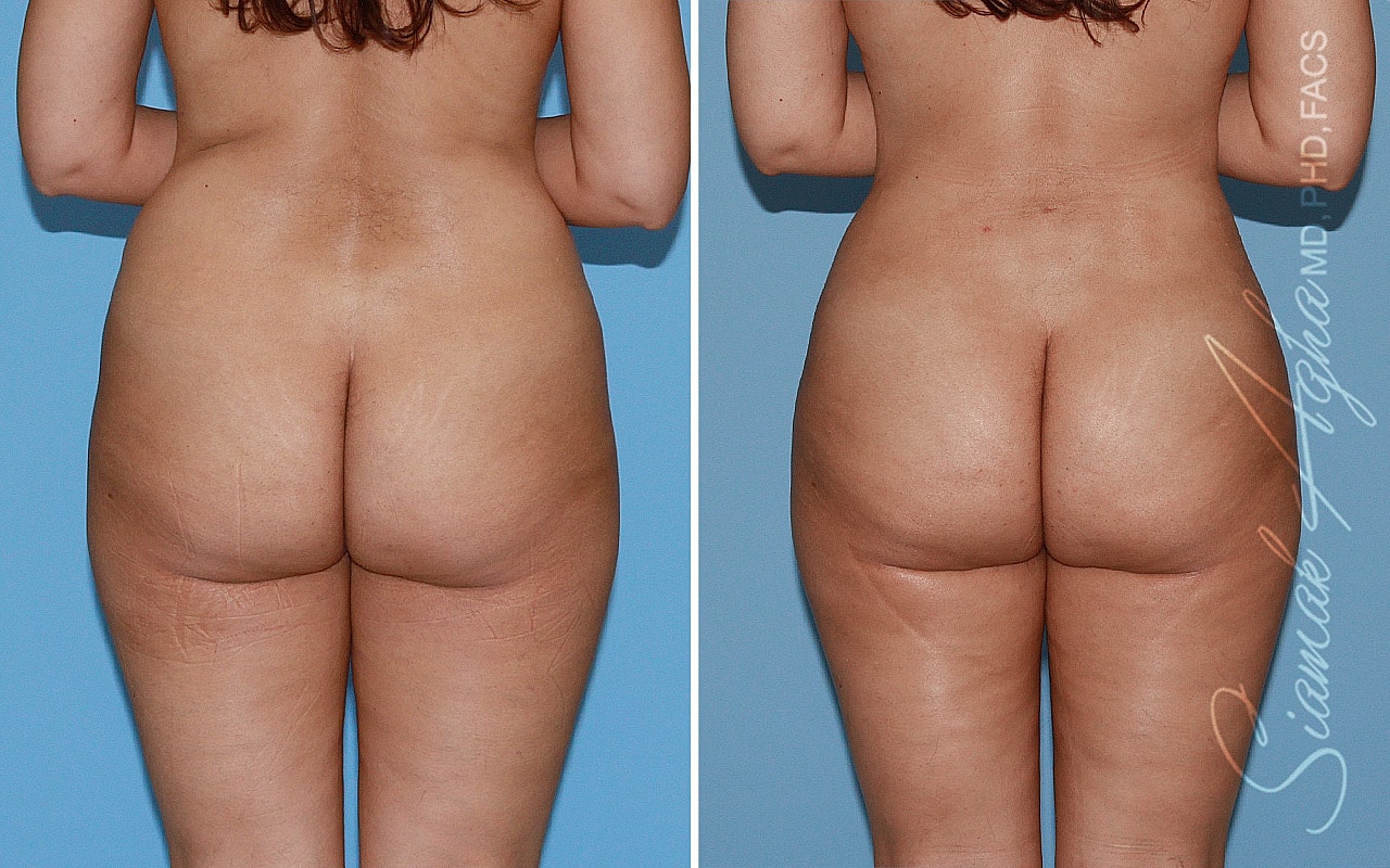 Liposuction Before & After