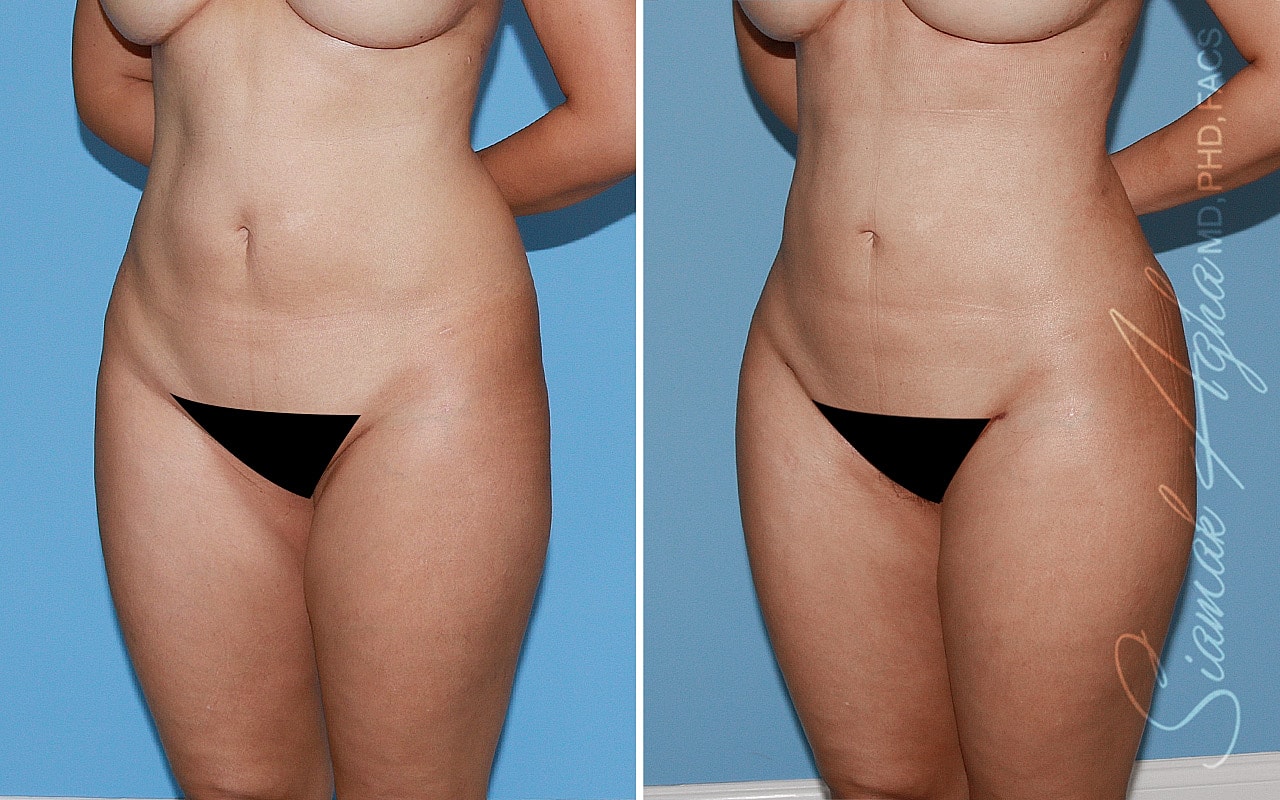 Liposuction Before & After