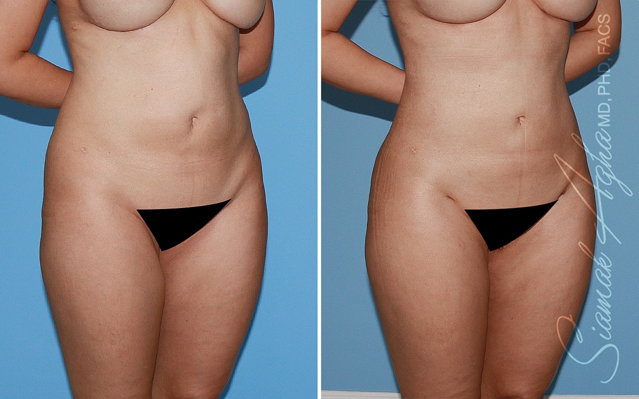 Liposuction Before & After