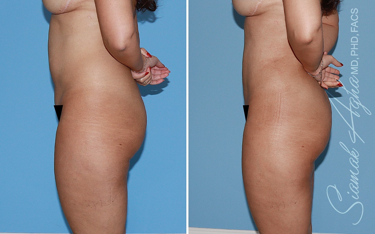 Liposuction Before & After