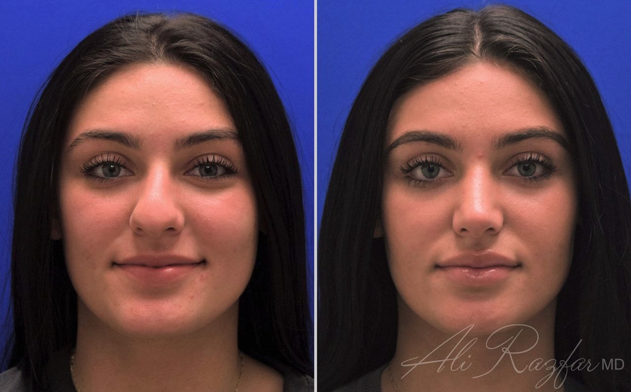 Rhinoplasty Before & After