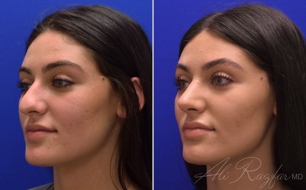 Rhinoplasty Before & After