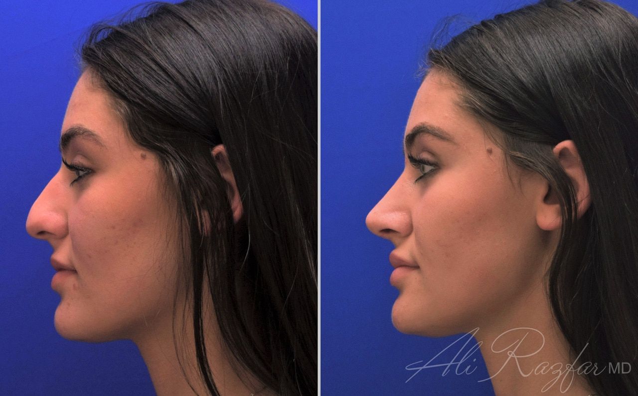 Rhinoplasty Before & After