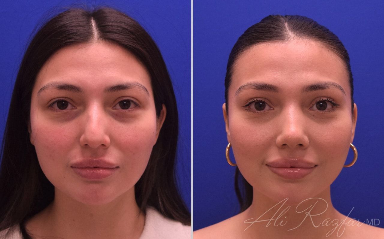 Rhinoplasty Before & After