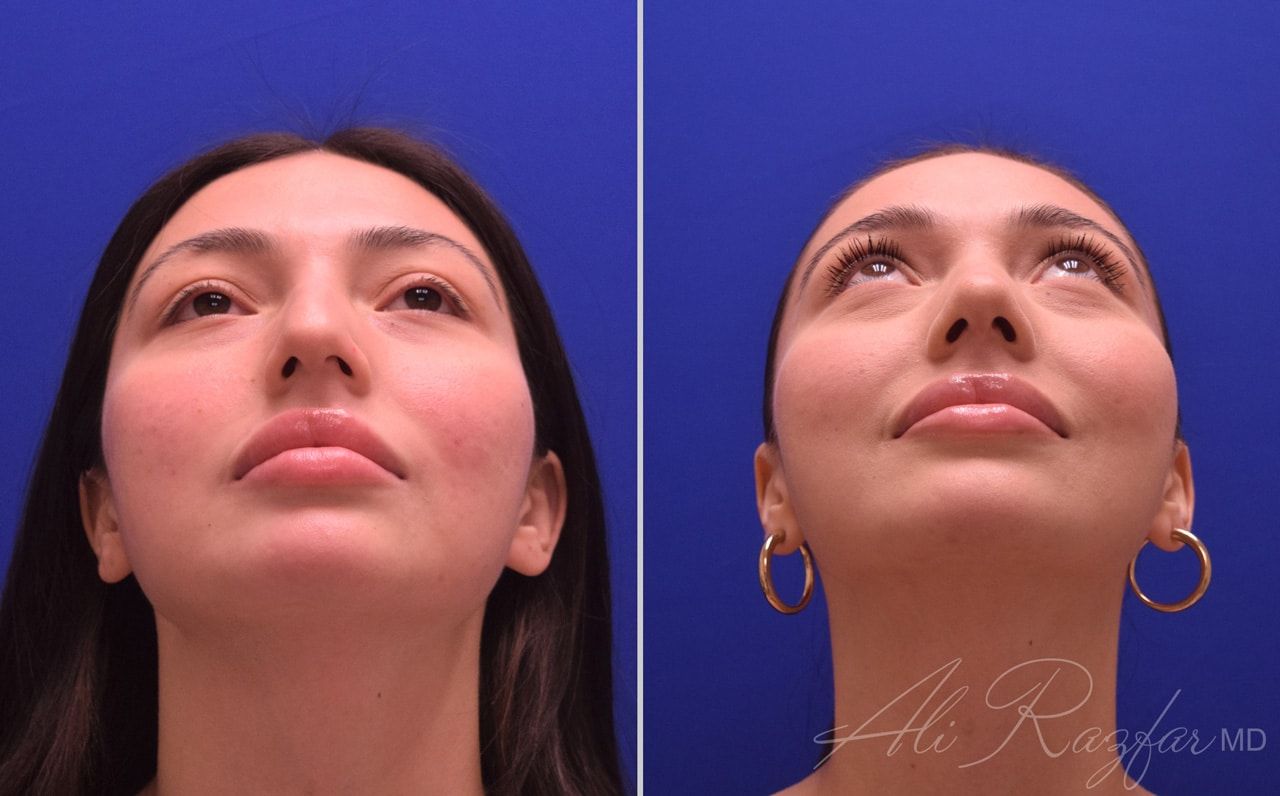 Rhinoplasty Before & After