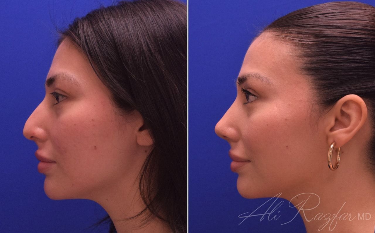 Rhinoplasty Before & After