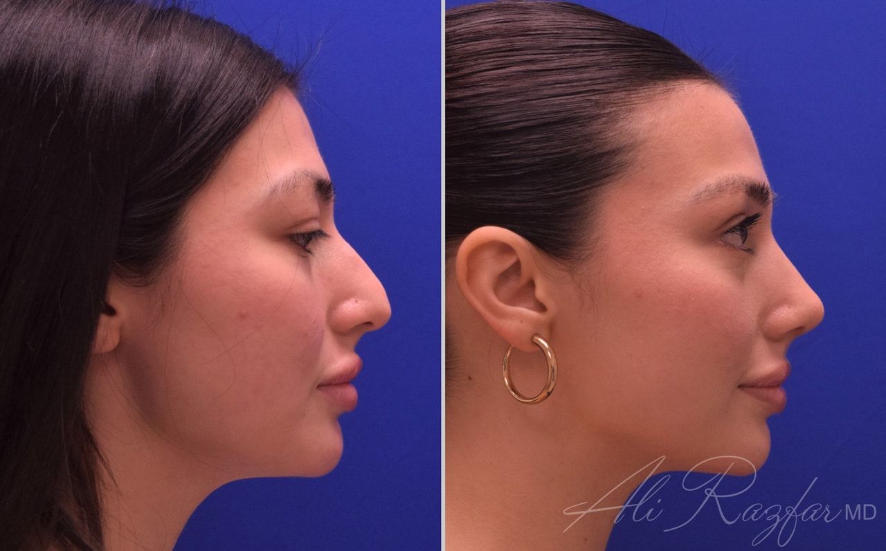 Rhinoplasty Before & After