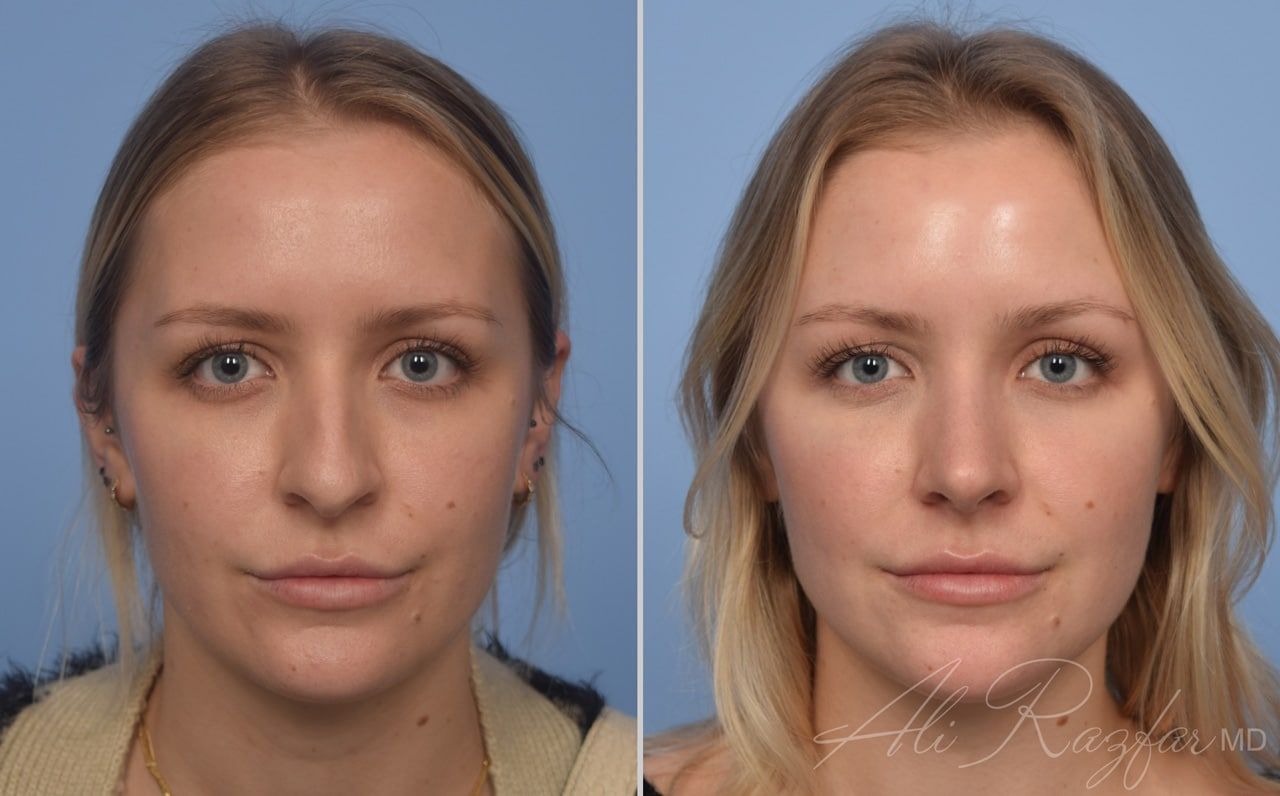 Rhinoplasty Before & After