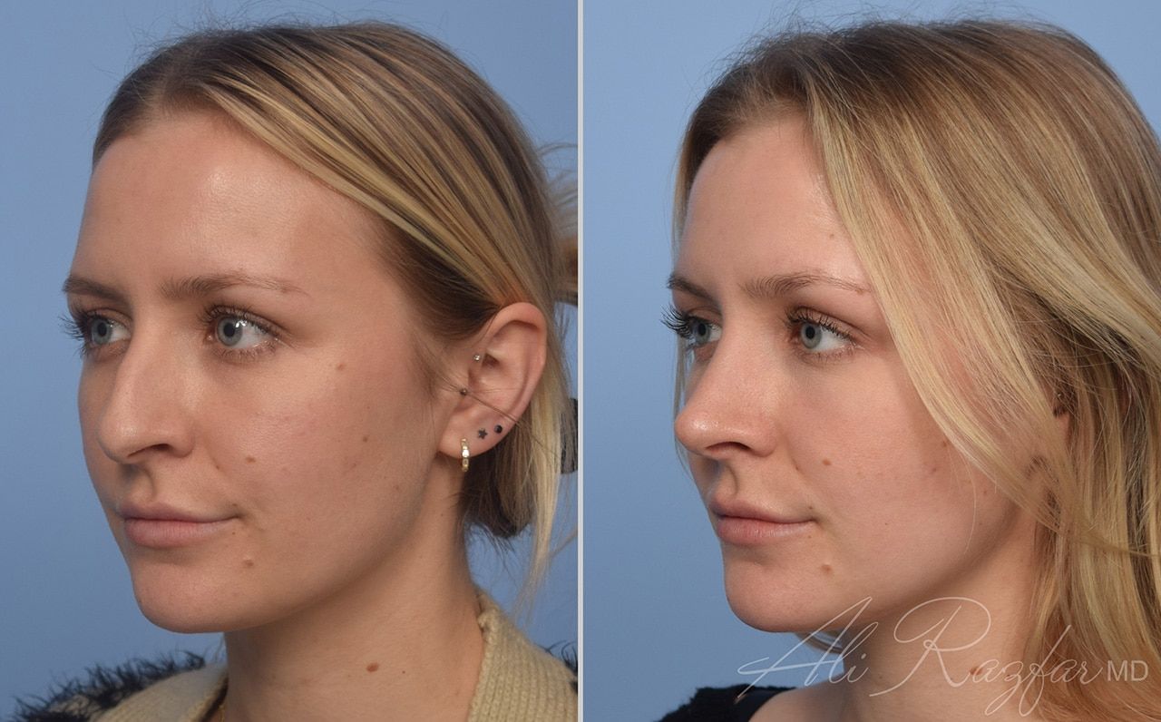 Rhinoplasty Before & After