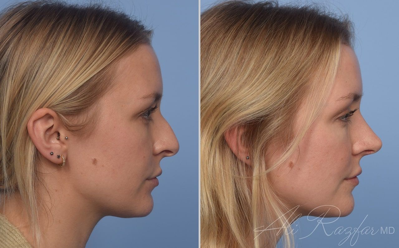 Rhinoplasty Before & After