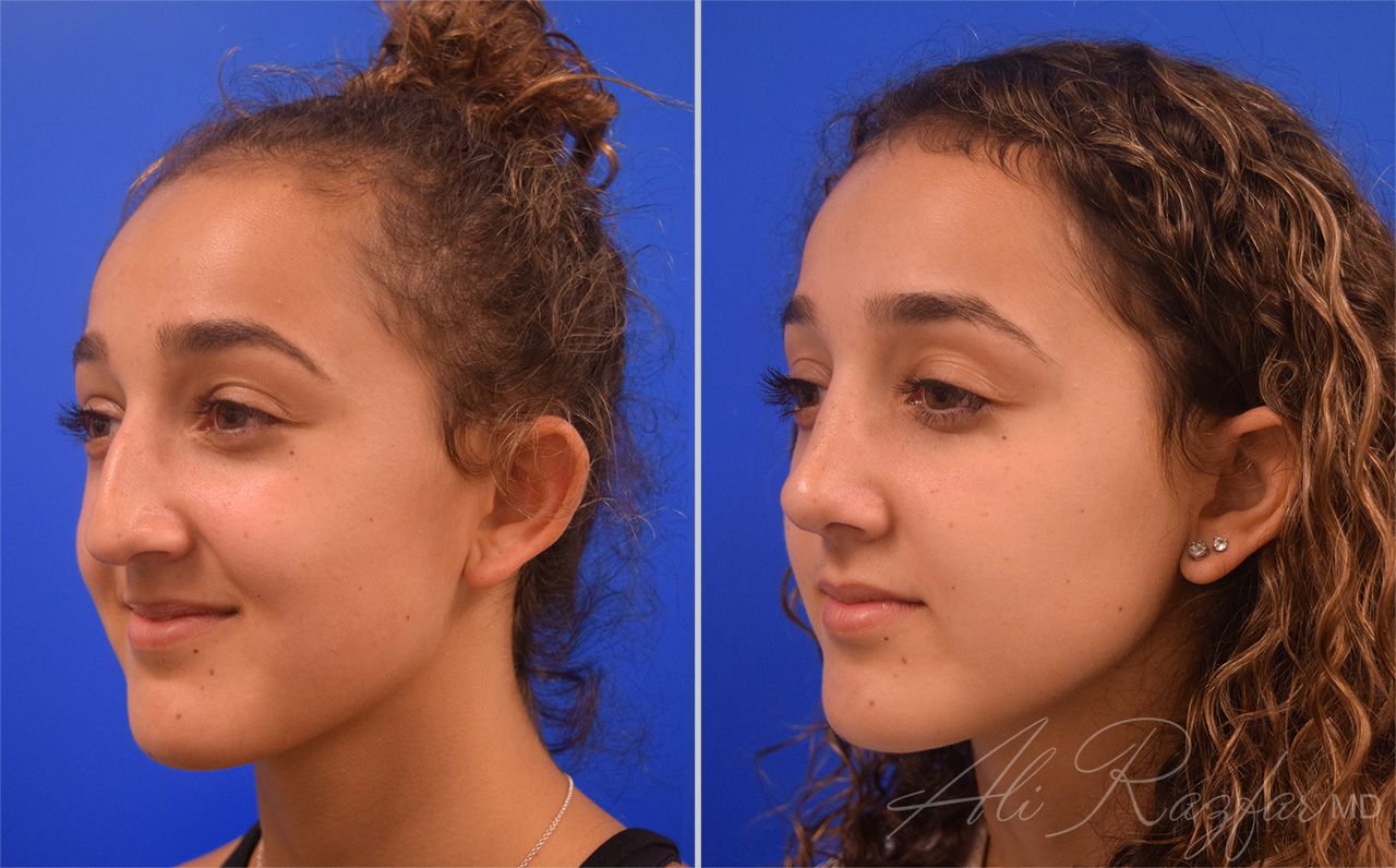 Rhinoplasty Before & After