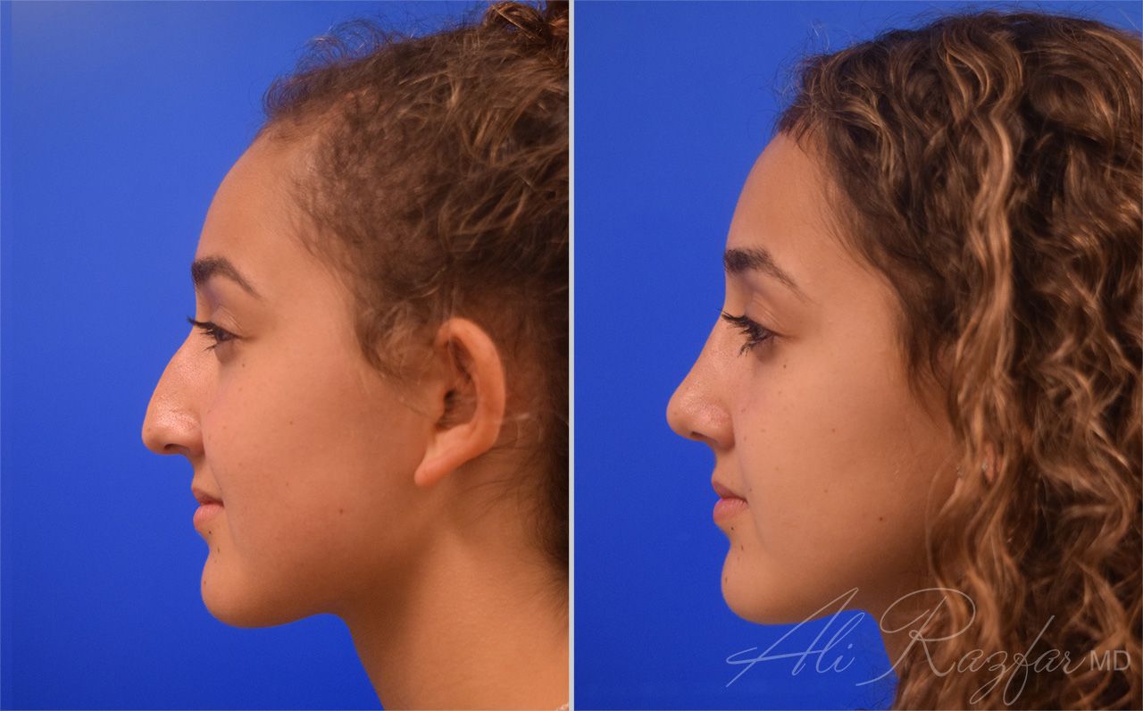 Rhinoplasty Before & After