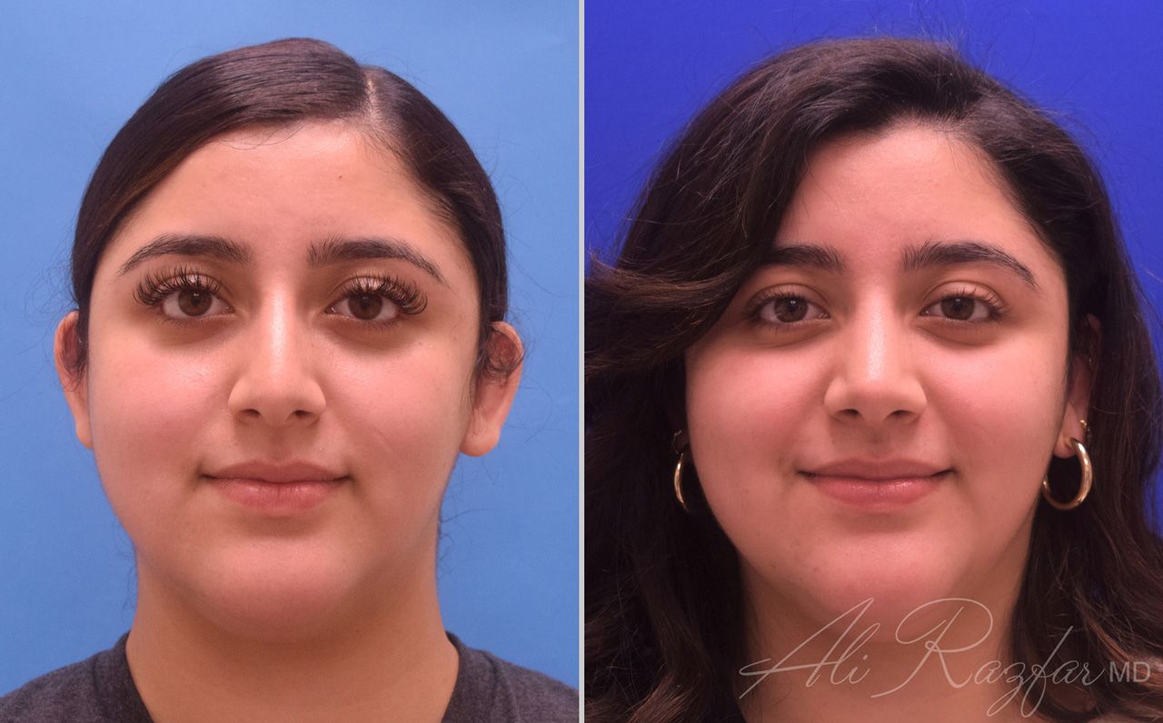 Rhinoplasty Before & After