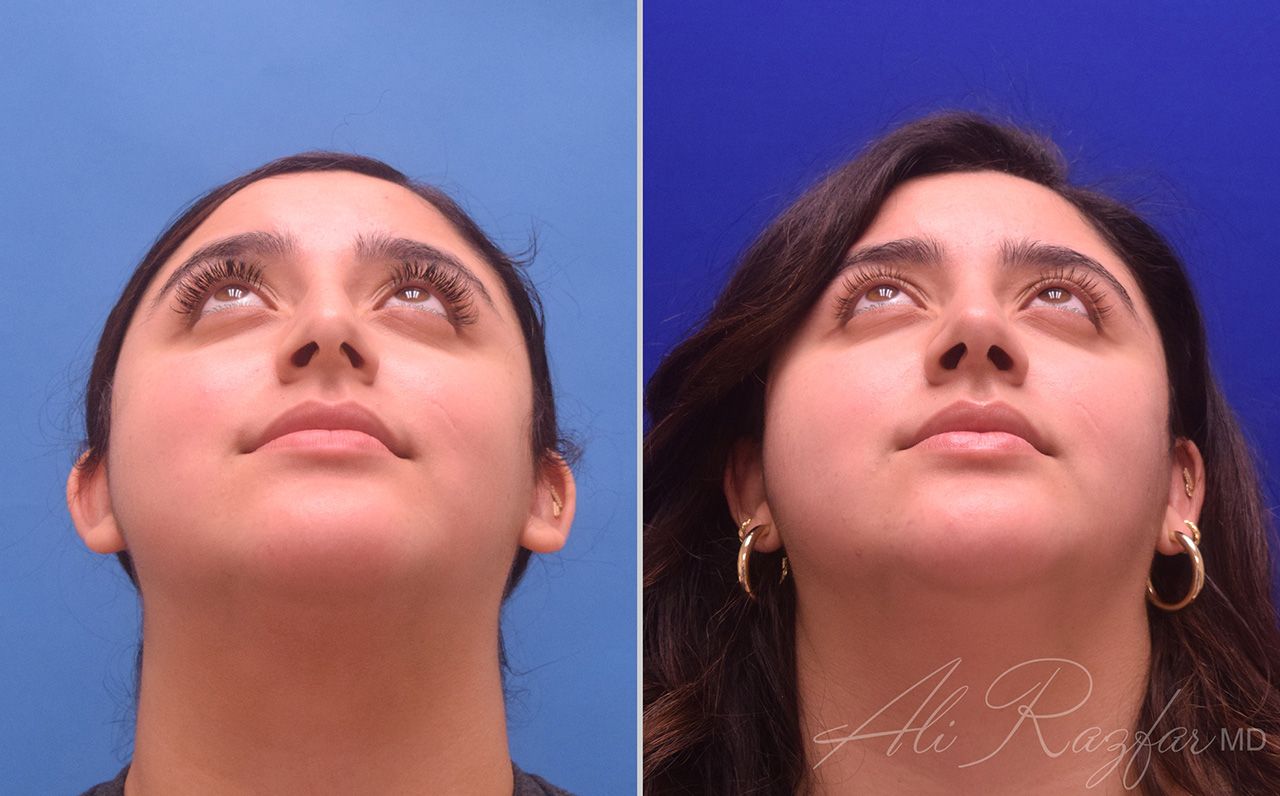 Rhinoplasty Before & After