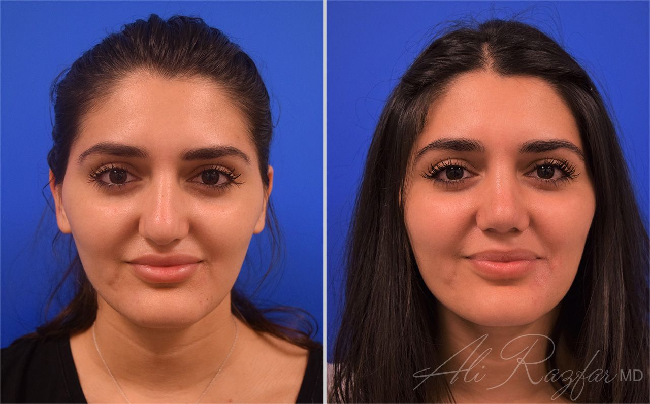 Rhinoplasty Before & After