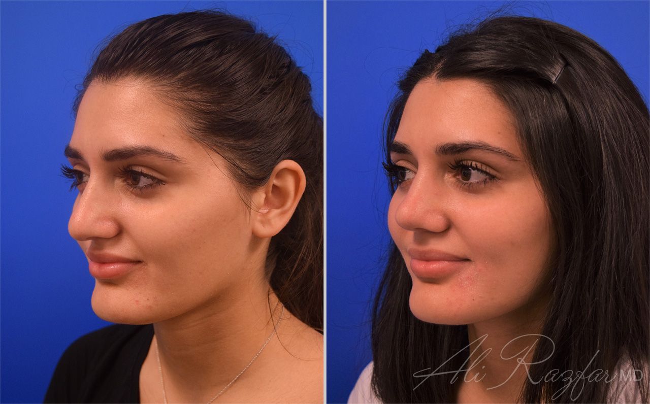 Rhinoplasty Before & After