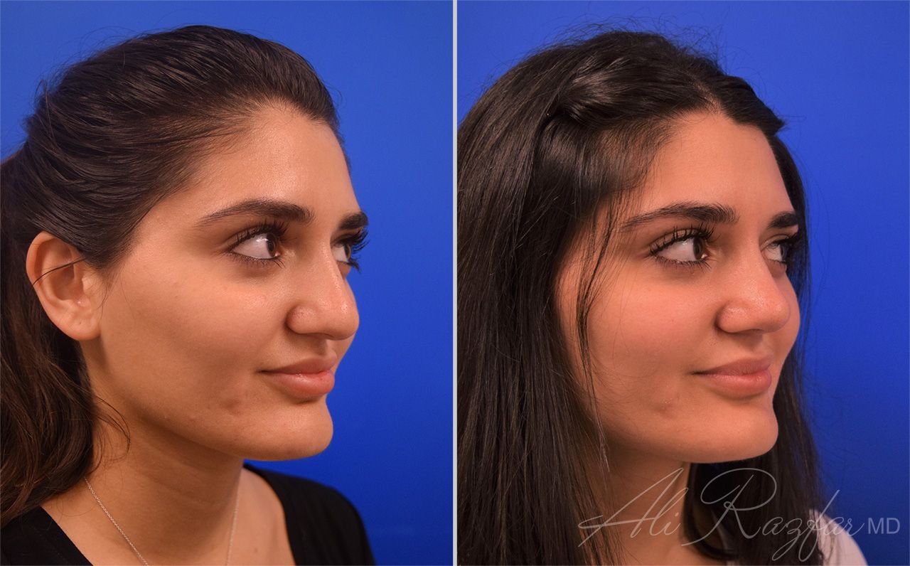 Rhinoplasty Before & After