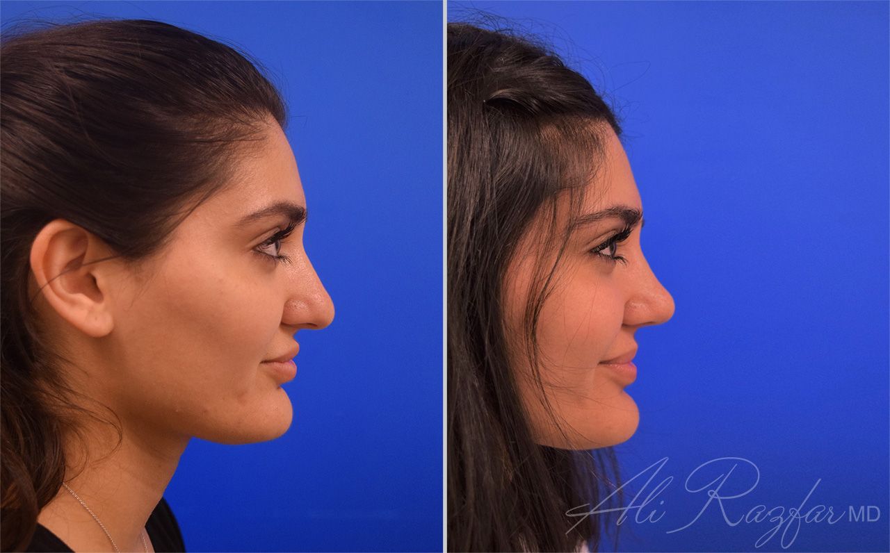 Rhinoplasty Before & After