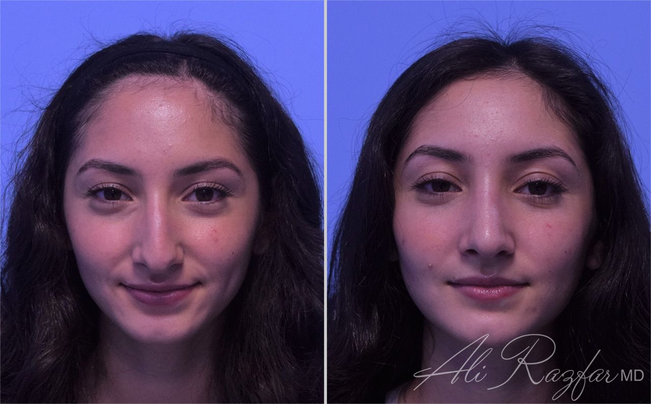 Rhinoplasty Before & After