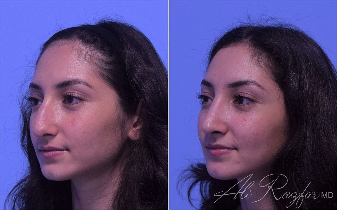 Rhinoplasty Before & After