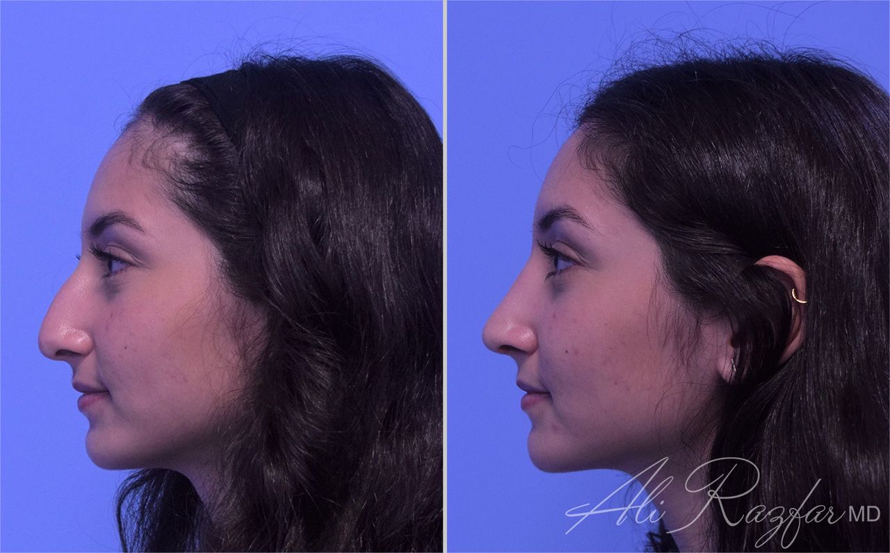 Rhinoplasty Before & After