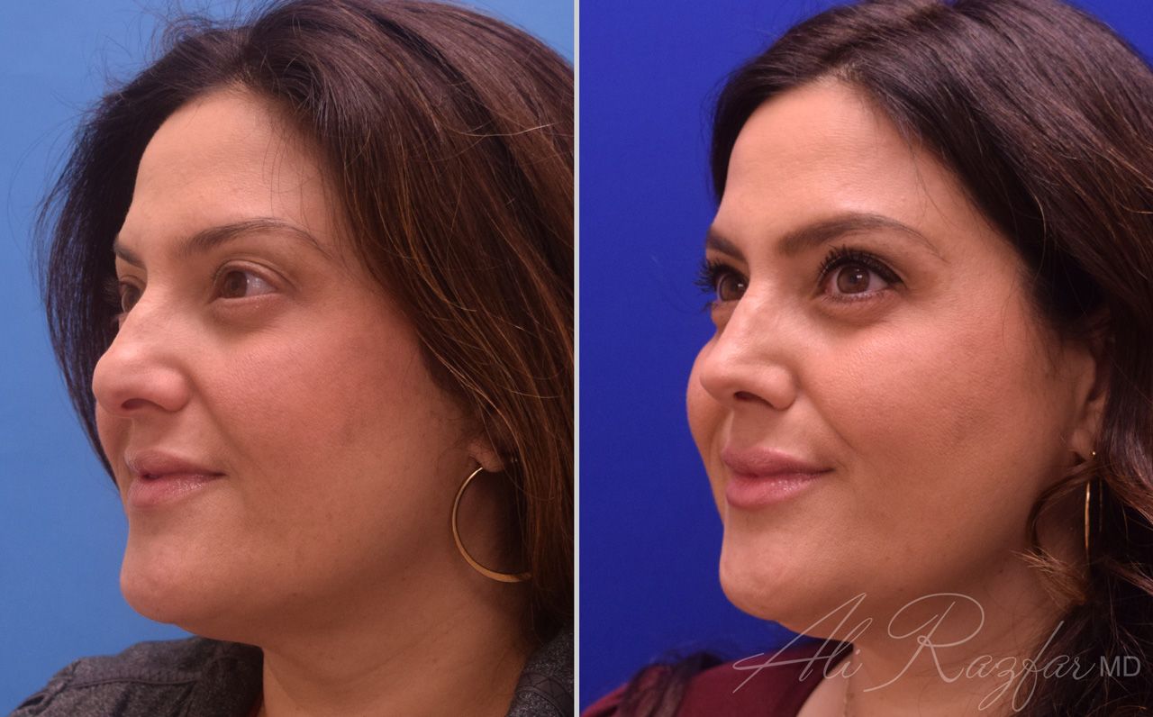 Rhinoplasty Before & After
