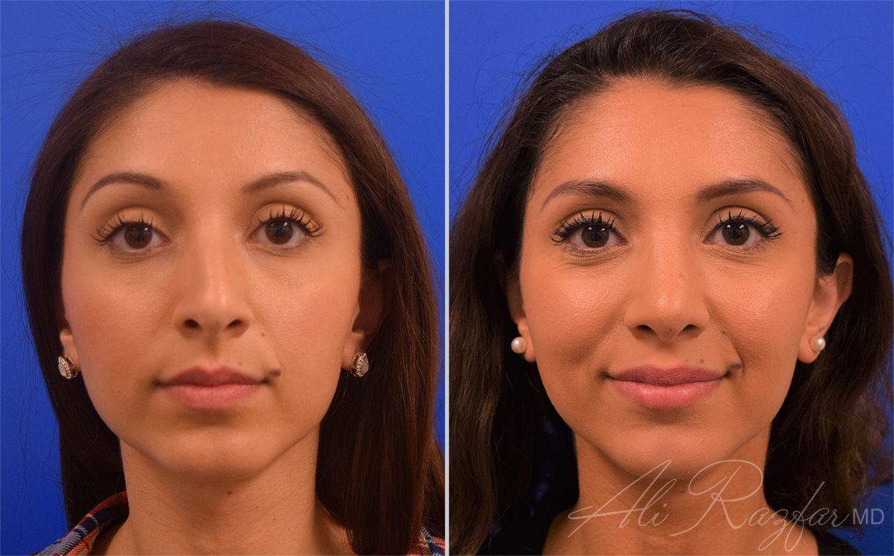 Rhinoplasty Before & After