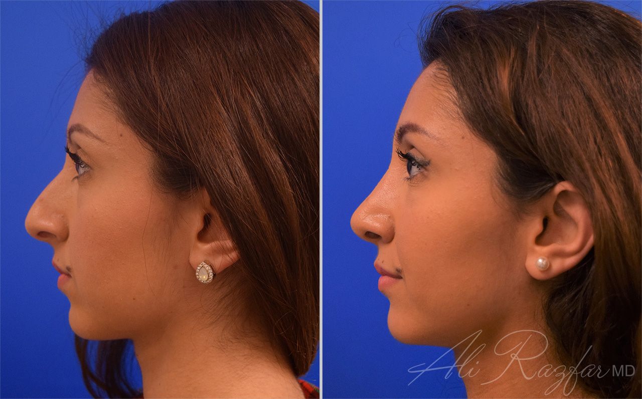 Rhinoplasty Before & After