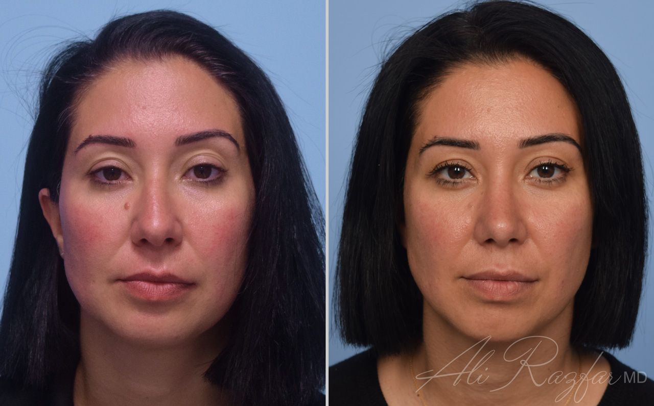 Rhinoplasty Before & After