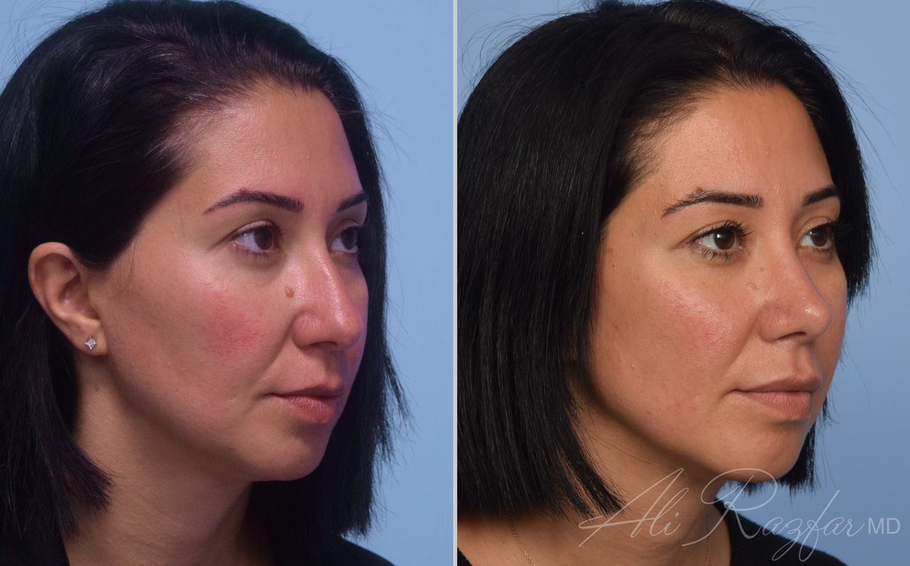 Rhinoplasty Before & After