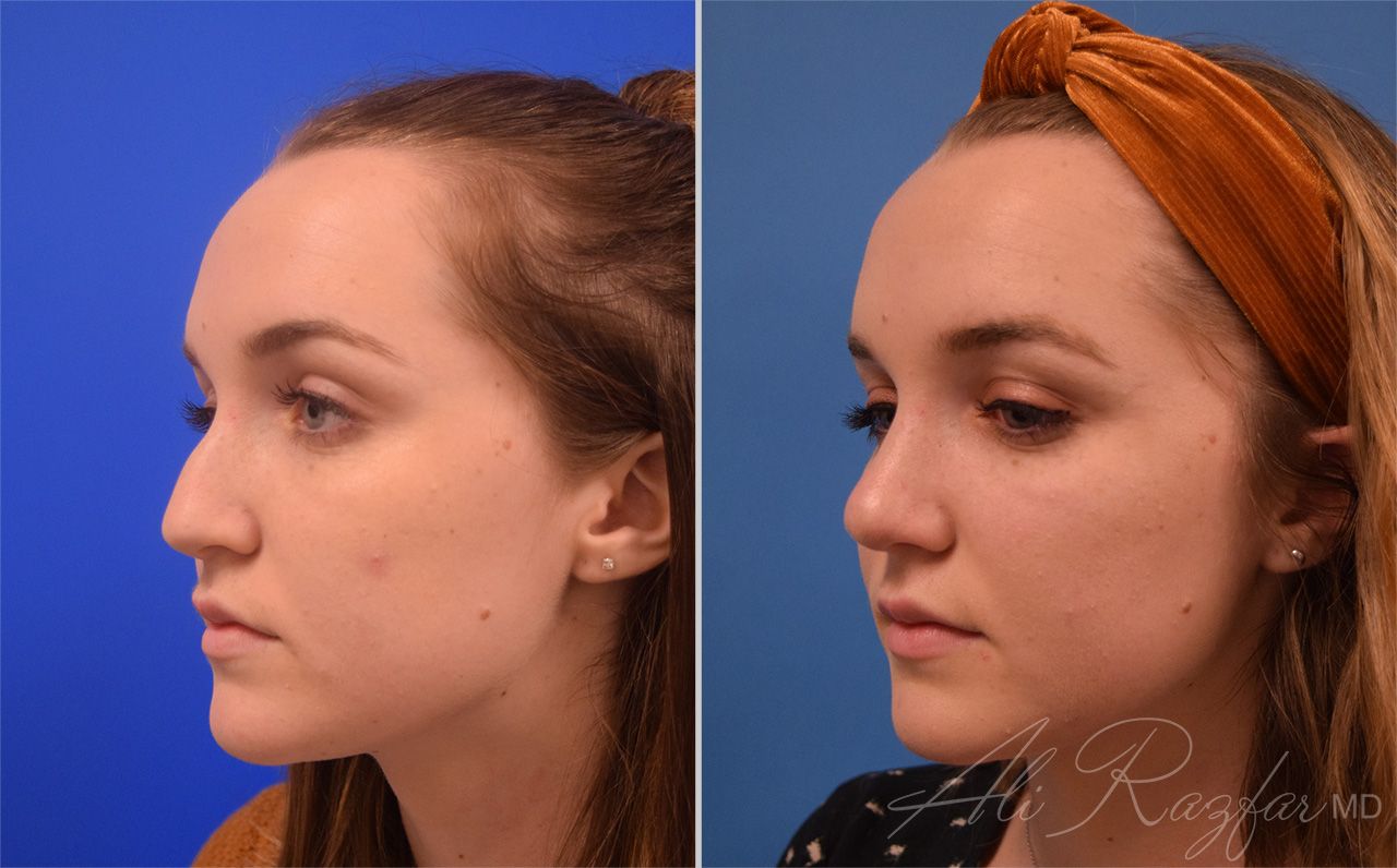 Rhinoplasty Before & After