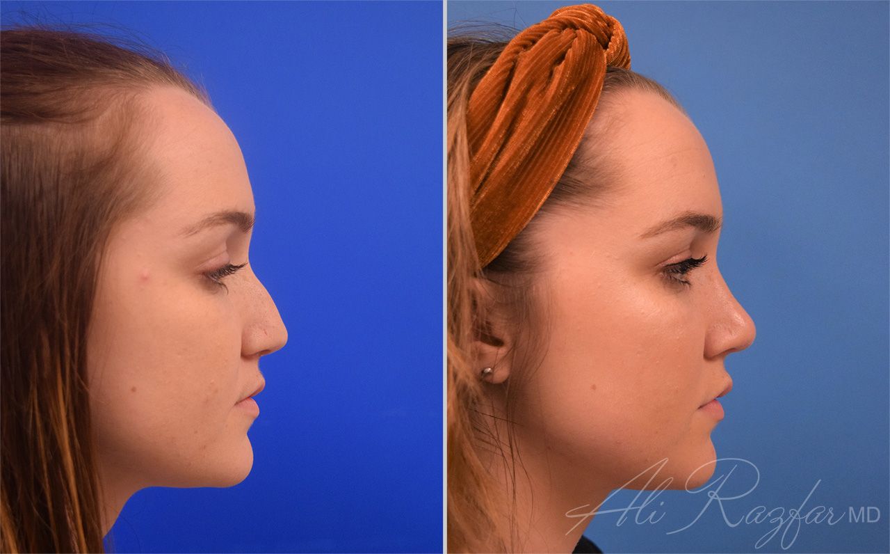 Rhinoplasty Before & After
