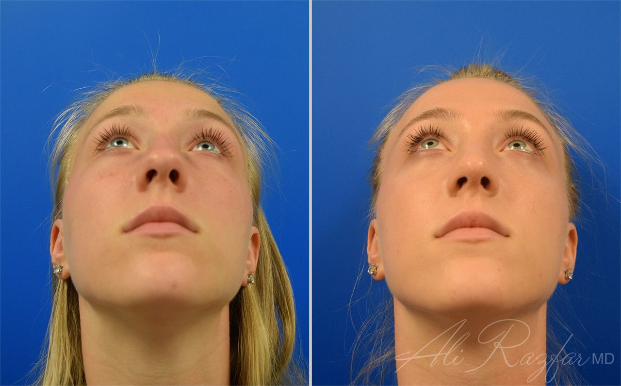 Rhinoplasty Before & After