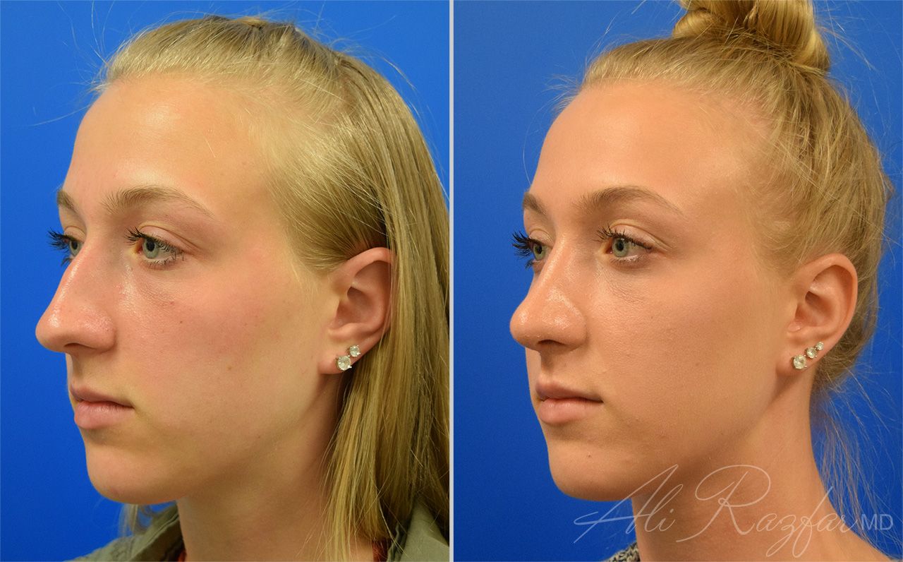Rhinoplasty Before & After