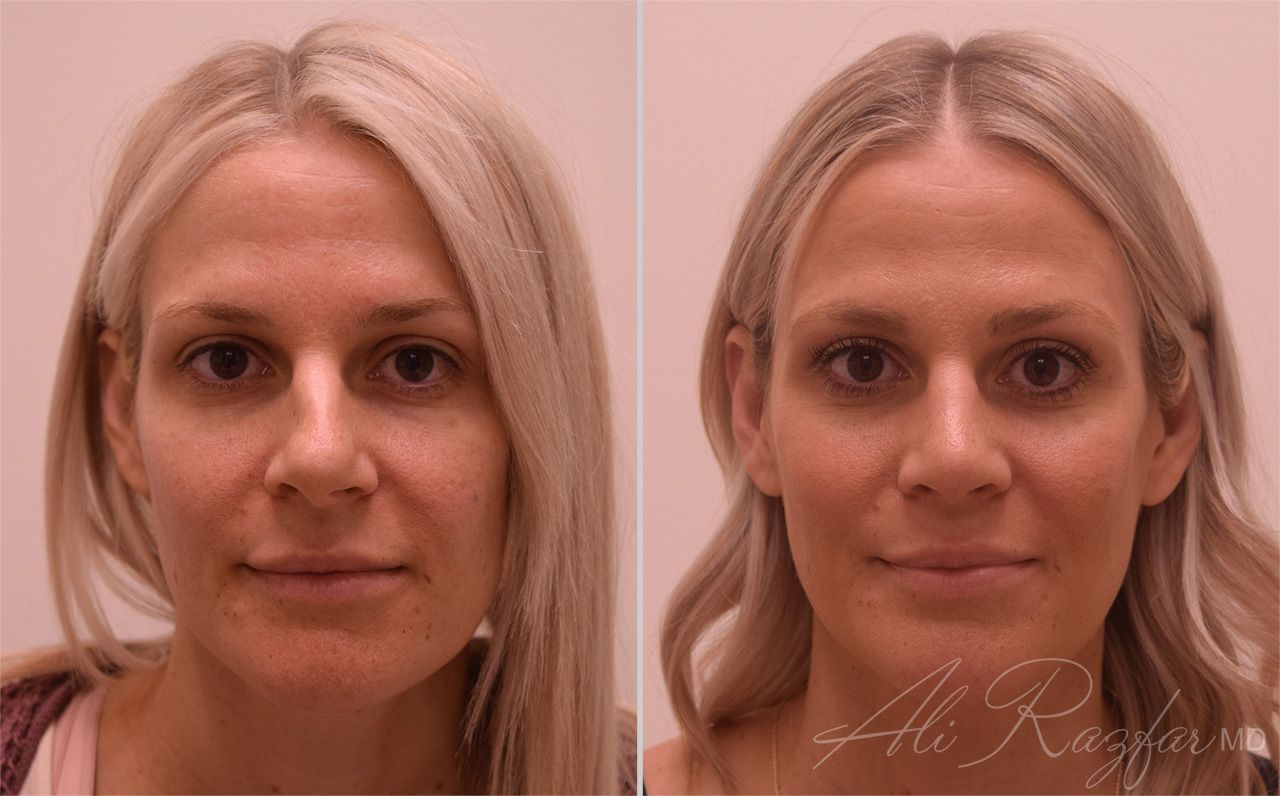 Rhinoplasty Before & After