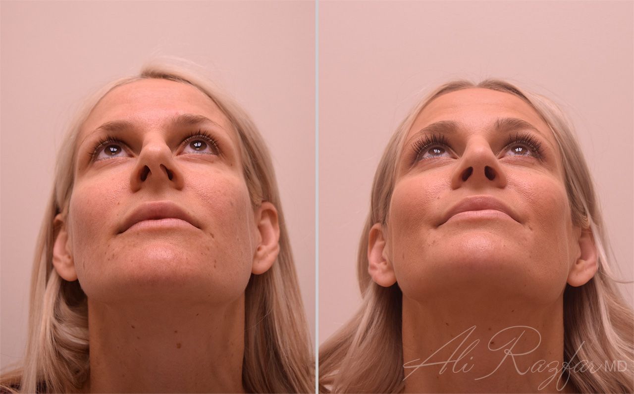 Rhinoplasty Before & After
