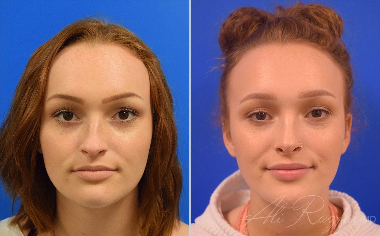 Rhinoplasty Before & After