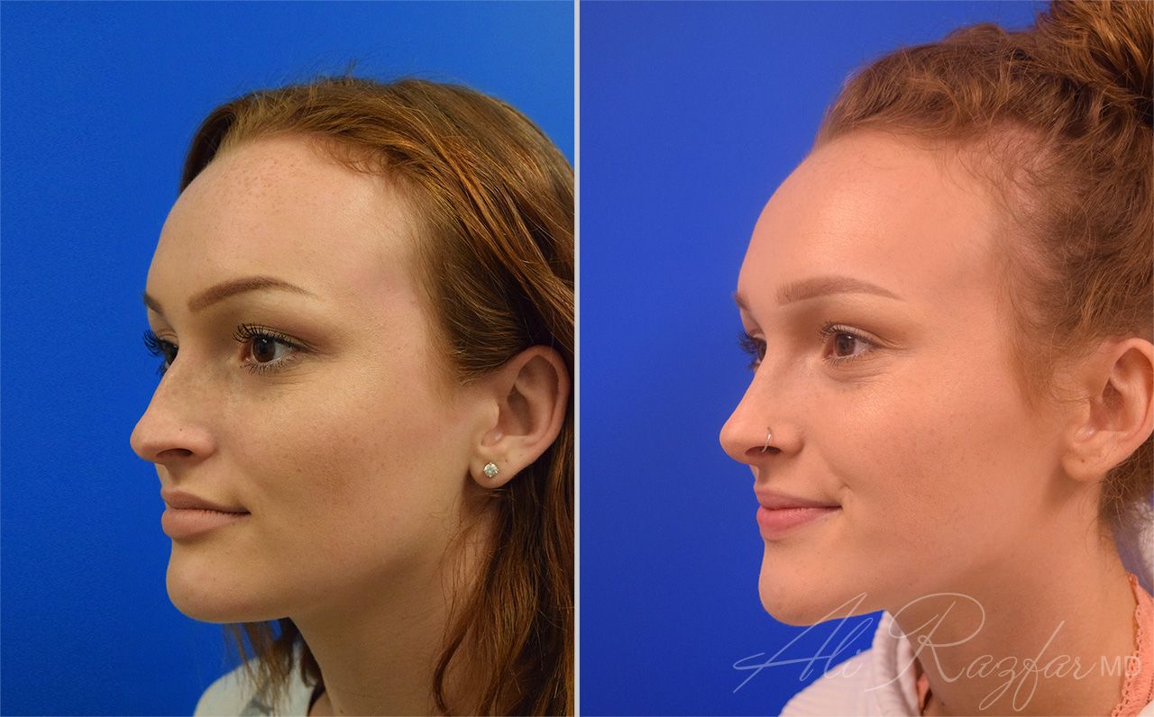 Rhinoplasty Before & After