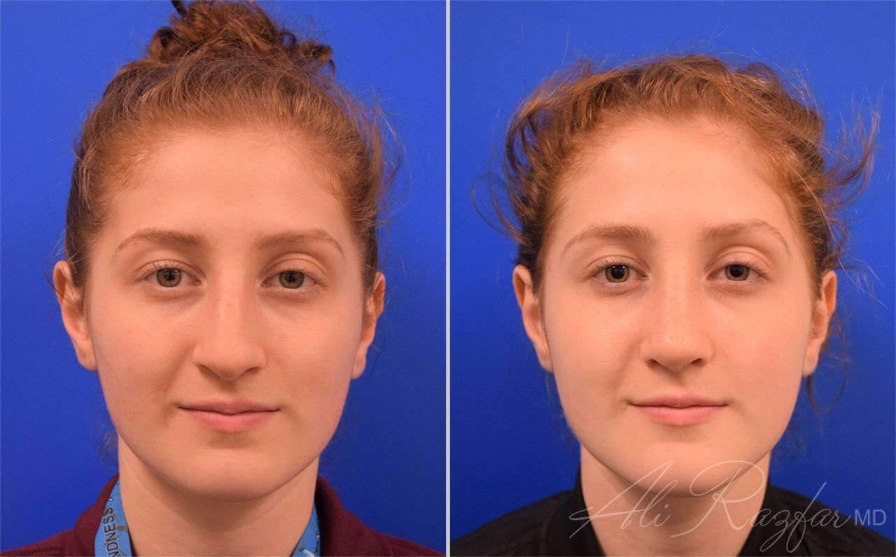 Rhinoplasty Before & After