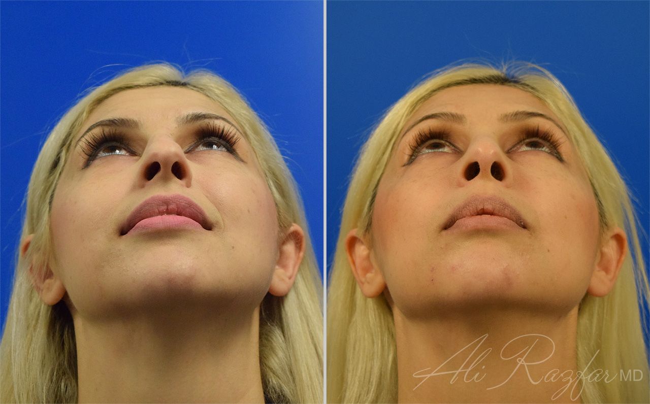 Rhinoplasty Before & After