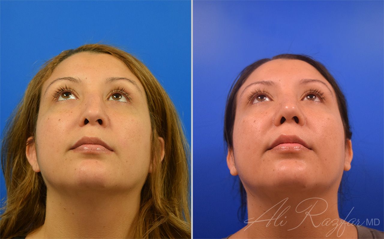 Rhinoplasty Before & After