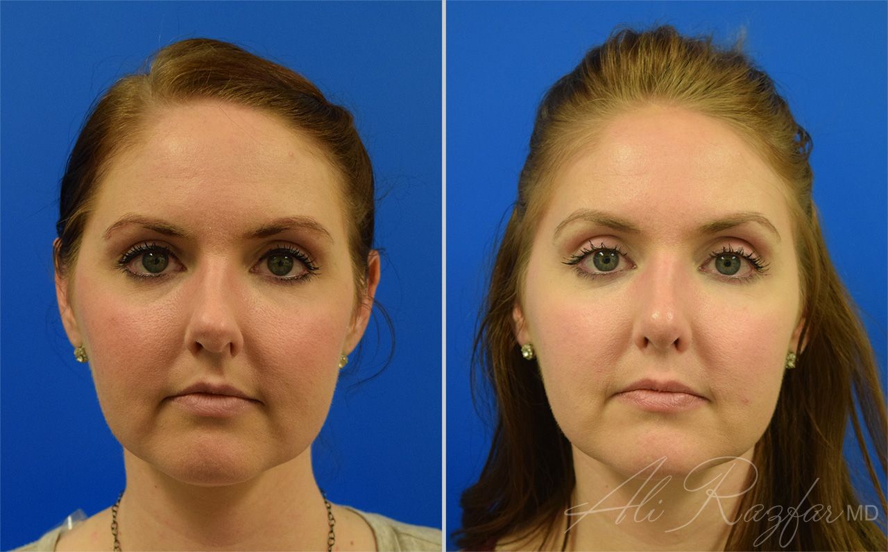 Rhinoplasty Before & After