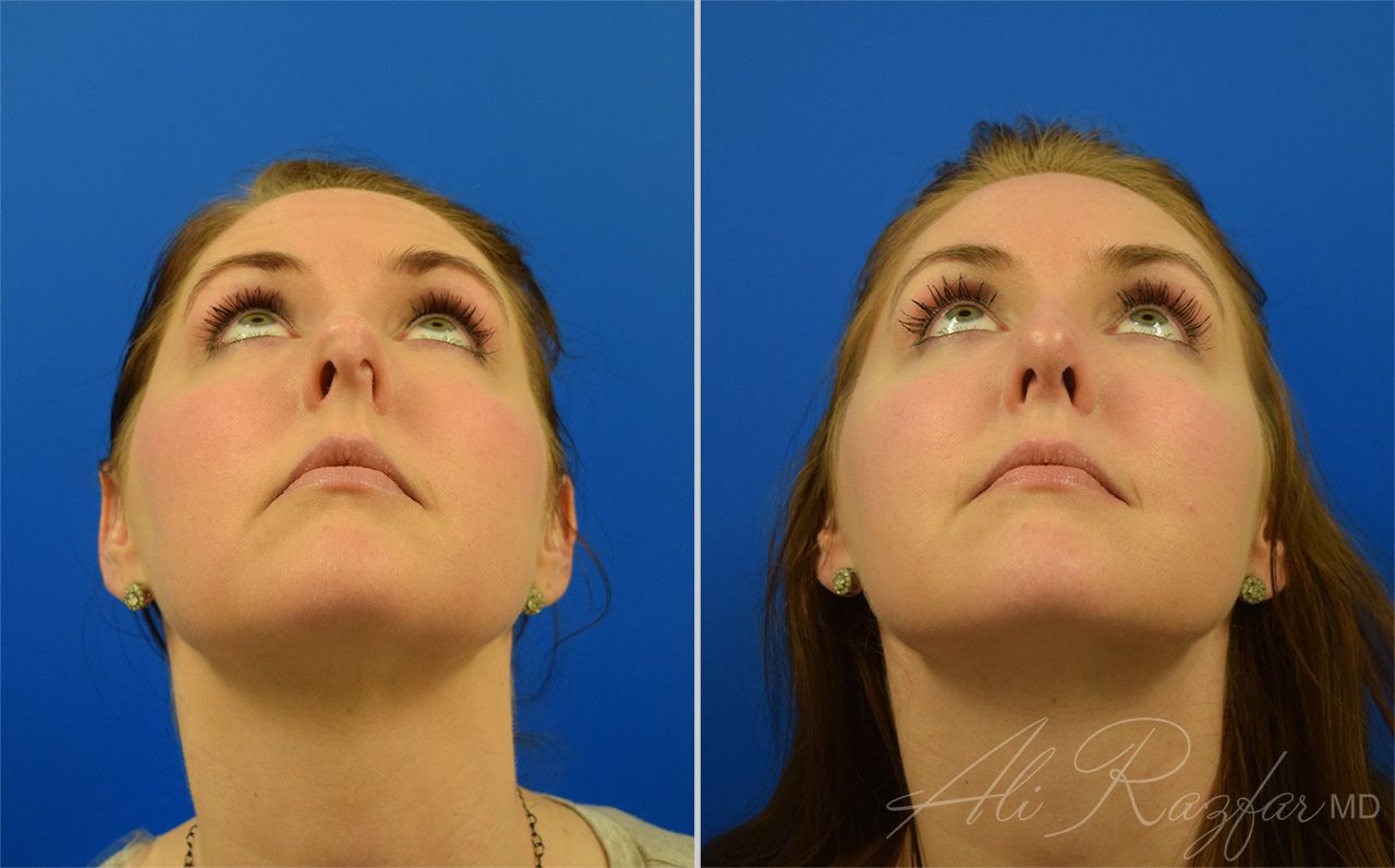 Rhinoplasty Before & After