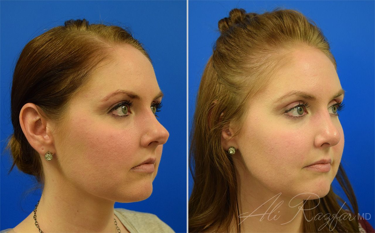 Rhinoplasty Before & After